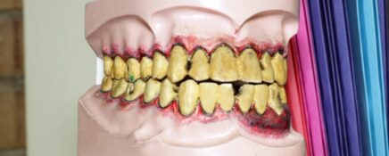 Dental assistant job duties may include educating patients using visual aids, such as this detailed model of teeth with severe plaque buildup and gum disease for oral hygiene instruction.