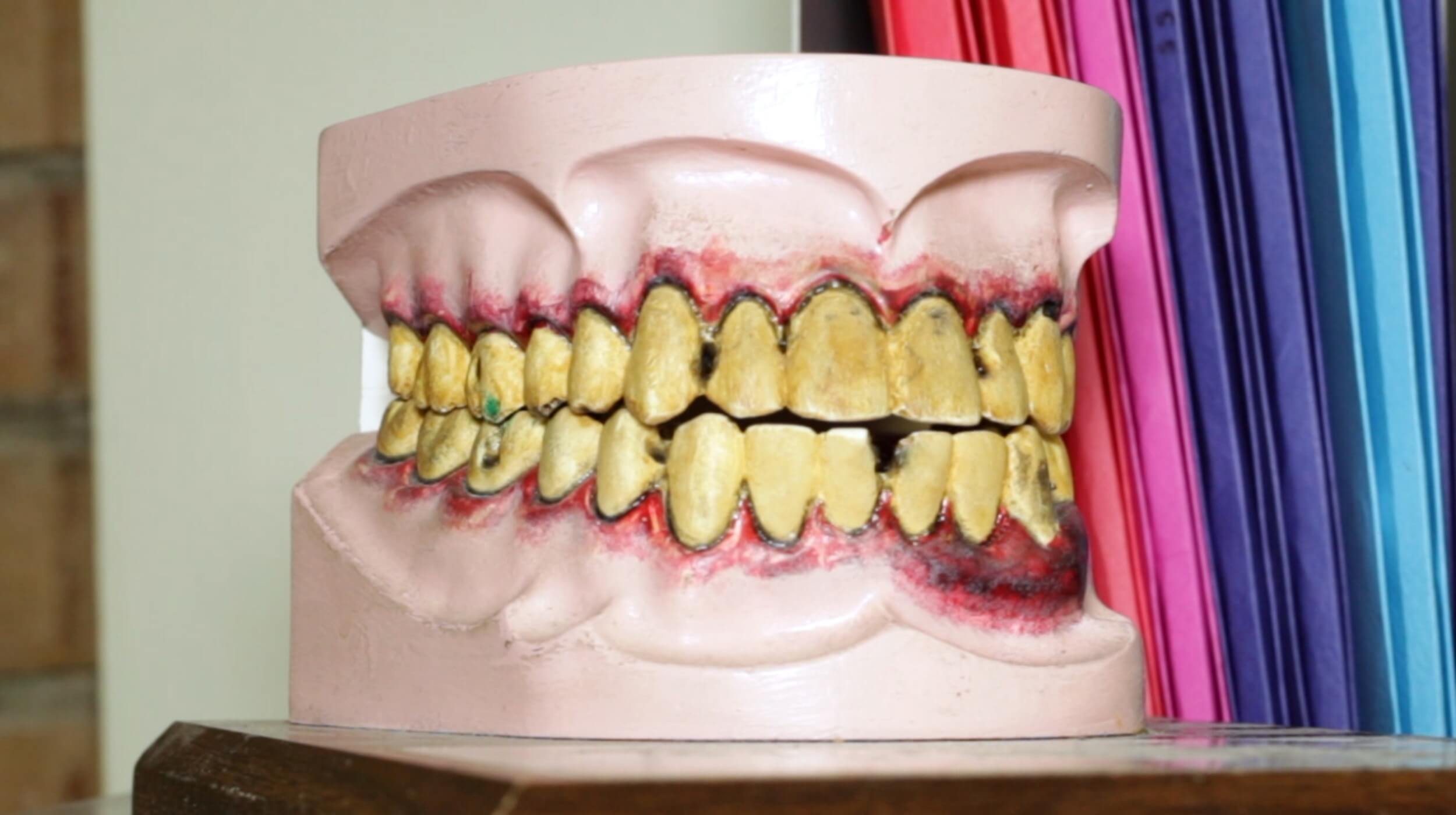 Dental assistant job duties may include educating patients using visual aids, such as this detailed model of teeth with severe plaque buildup and gum disease for oral hygiene instruction.